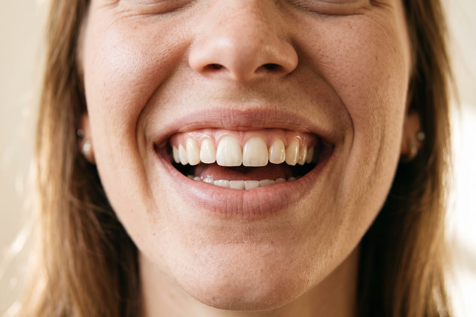 A close-up of a natural smile after composite edge bonding on the front teeth